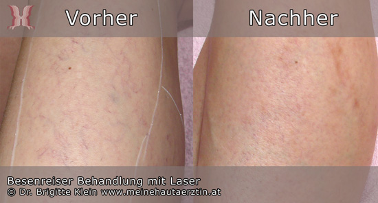 Besenreiser Behandlung mit Laser Vorher Nachher Fotos