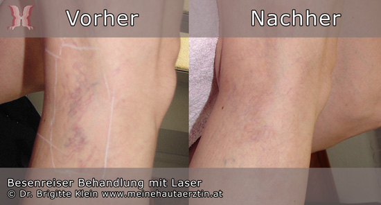 Besenreiser Behandlungsfotos von Hautärztin Dr. Klein