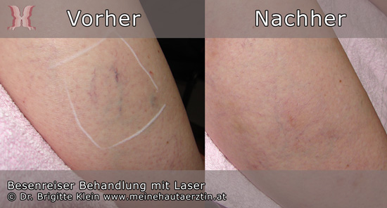 Besenreiser lasern bei Hautarzt Dr. Brigitte Klein in Wien