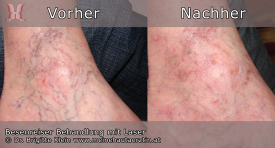 Besenreiser Behandlung mit Laser an einem Knöchel