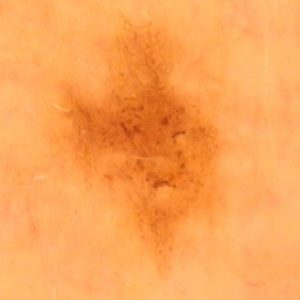 Muttermalkontrolle mittels Auflichtmikroskopie mit digitaler Fotodokumentation