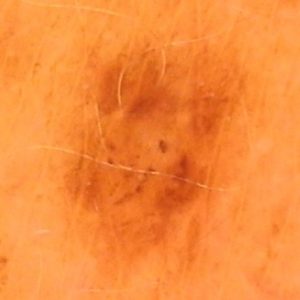 Muttermalkontrolle mittels Auflichtmikroskopie mit digitaler Fotodokumentation 