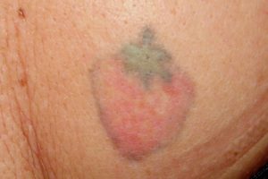 Tattooentfernung Vorher-Nachher Bilder buntes Tattoo vor Lasern