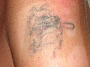 Tattooentfernung Oberarm - Tattoo nach einer Laserbehandlung