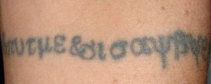 Tattooentfernung Vorher-Nachher Bilder - Tattoo vor der Behandlung