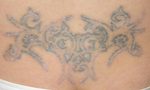 Tattooentfernung Steißbein- Tattoo nach der Laserbehandlung