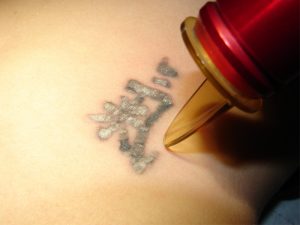 Tattooentfernung mit Laser- Tattoo nach der Behandlung