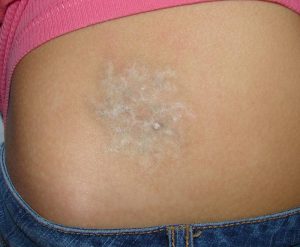 Tattooentfernung Vorher-Nachher Foto nach 19 Laserbehandlungen