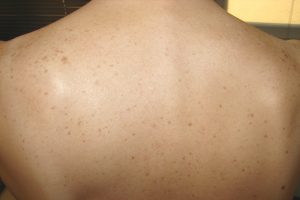 Altersflecken entfernen Vorher-Nachher Bild: Altersflecken am Rücken vor der Alterfleckenentfernung mit Laser bei Hautärztin Dr. Brigitte Klein in Wien.