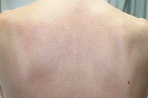 Altersflecken entfernen Vorher-Nachher Bild: Altersflecken am Rücken nach der Alterfleckenentfernung mit Laser bei Hautärztin Dr. Brigitte Klein in Wien.