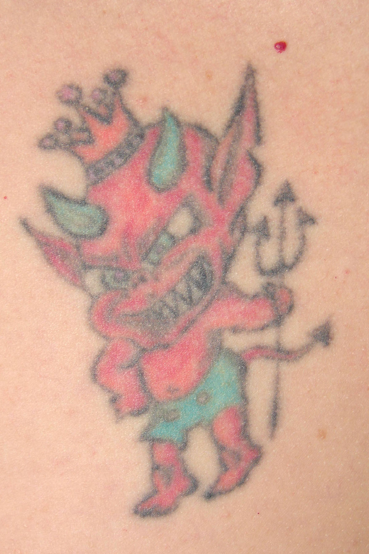 Tattooentfernung eines bunten Tattoos vor der Behandlung