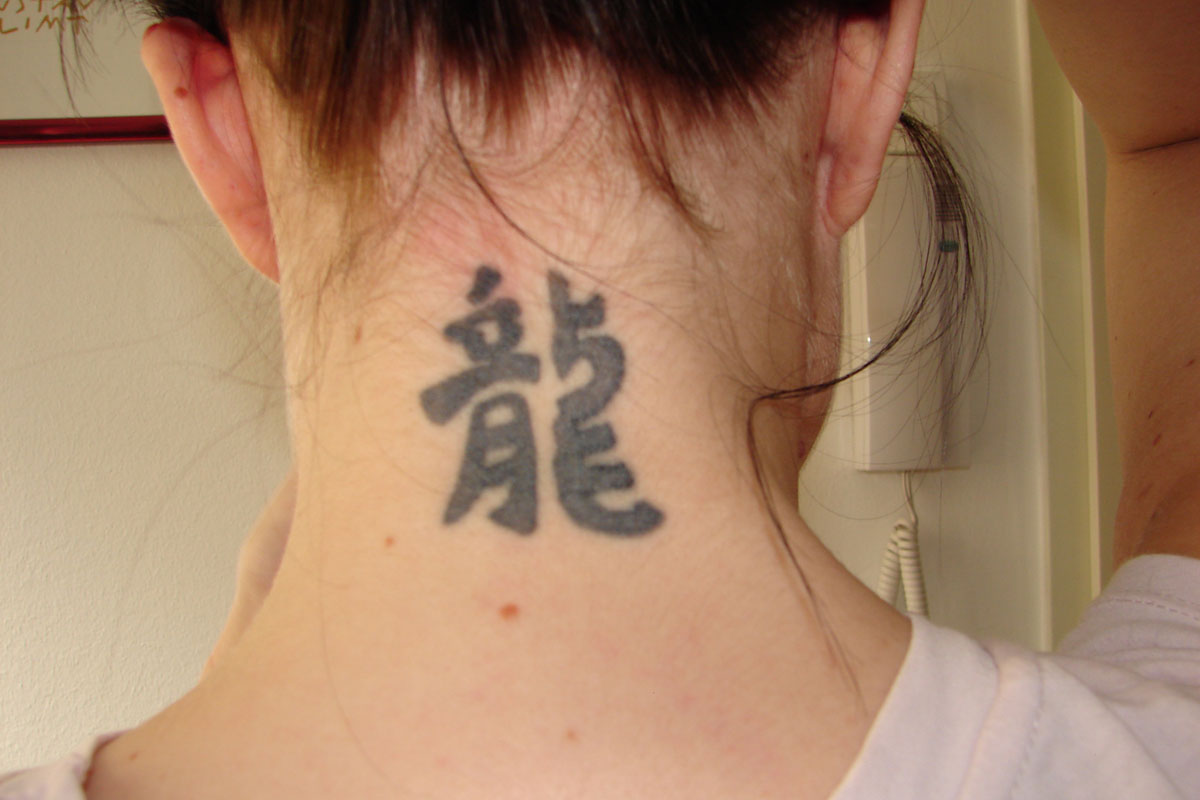 Tattooentfernung am Nacken