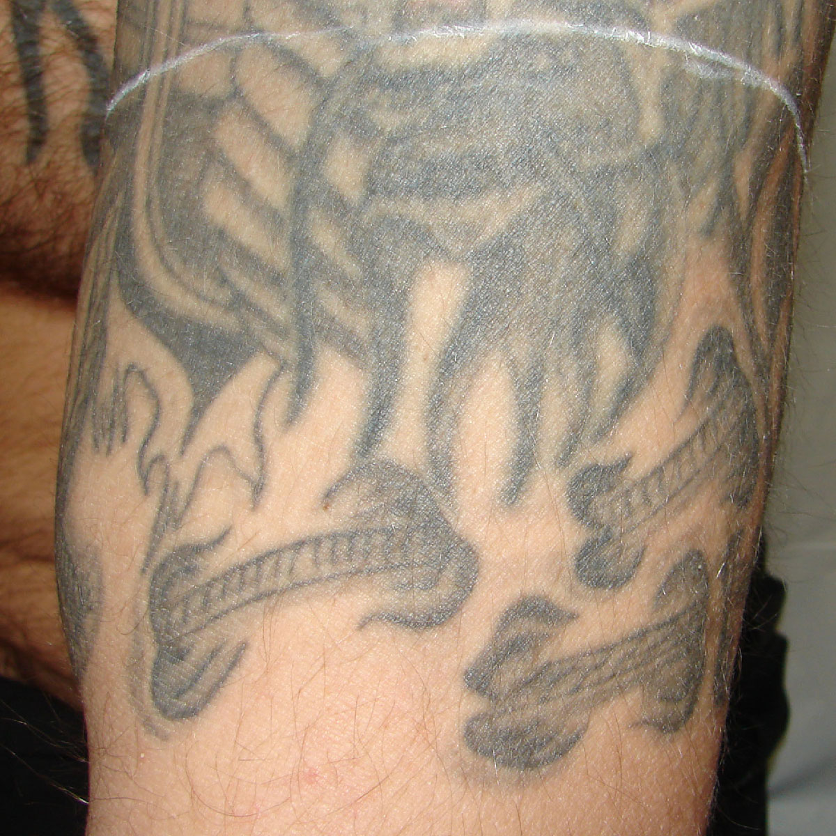 Tattooentfernung am Oberarm