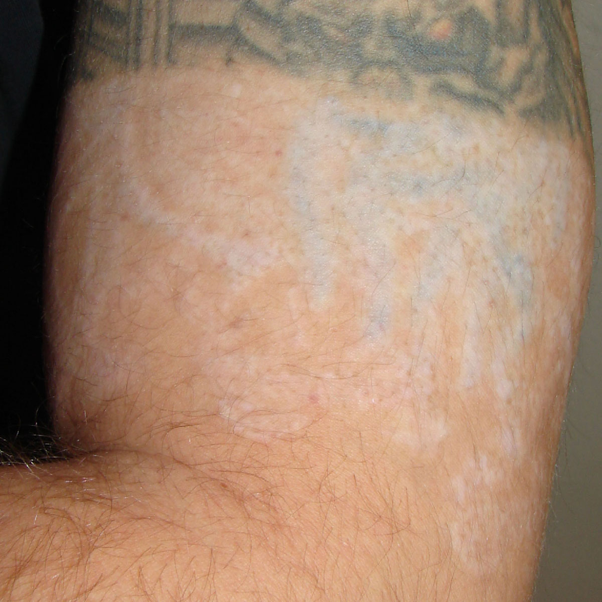 Tattooentfernung am Oberarm nach 13 Behandlungen