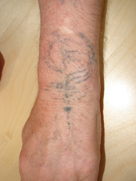 Tattooentfernung am Handrücken vor der Behandlung