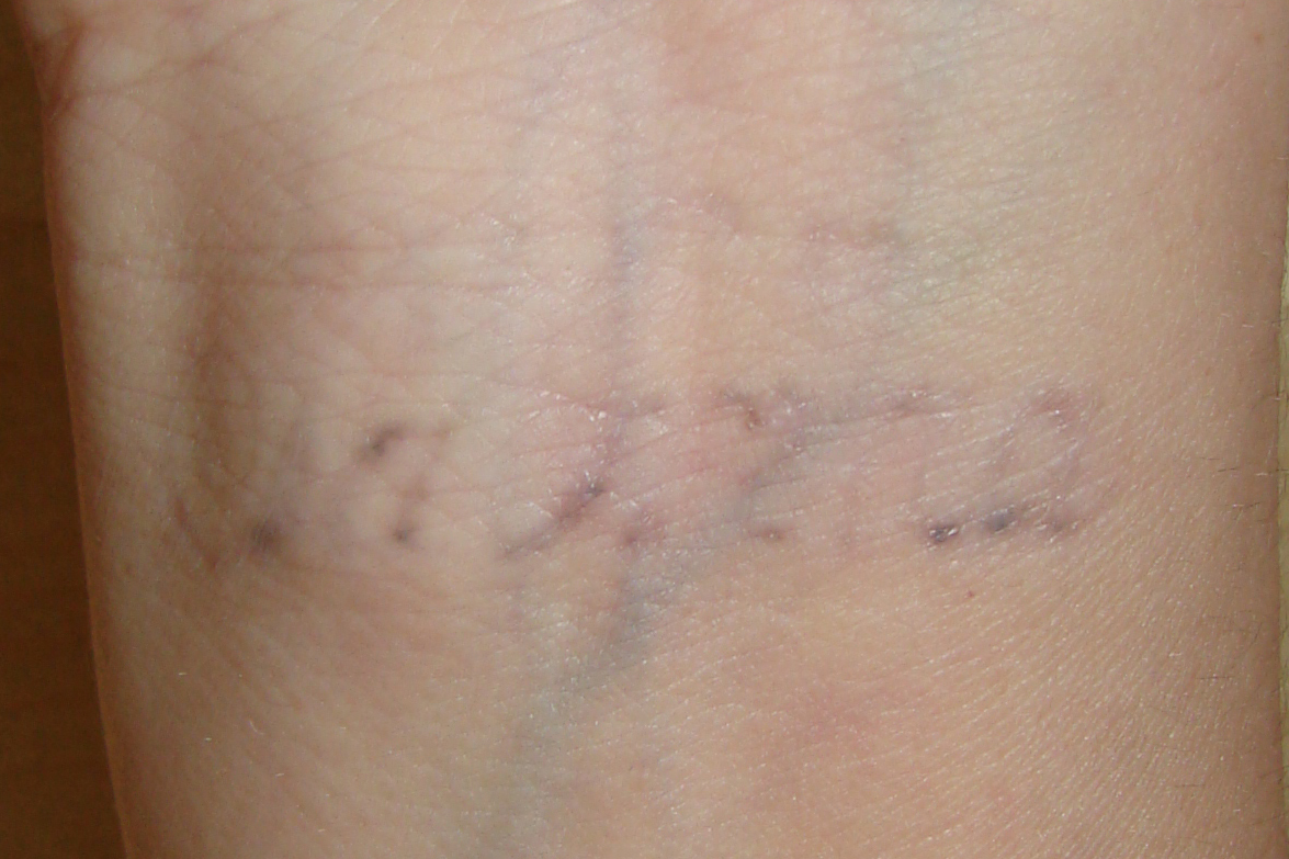 Tattooentfernung am Handgelenk nach 13 Behandlungen