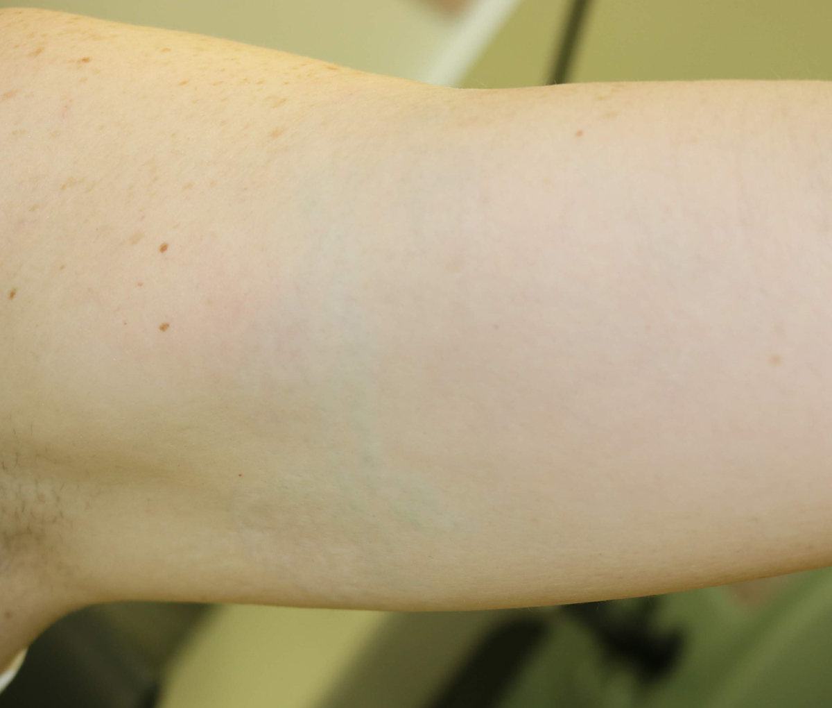 Tattooentfernung am Oberarm nach der 12. Behandlung