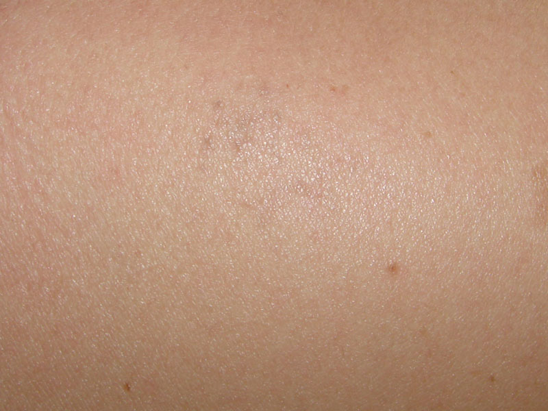 Tattooentfernung auf der Schulter nach 1 Behandlung