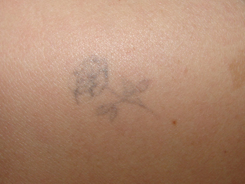 Tattooentfernung auf der Schulter vor der Behandlung