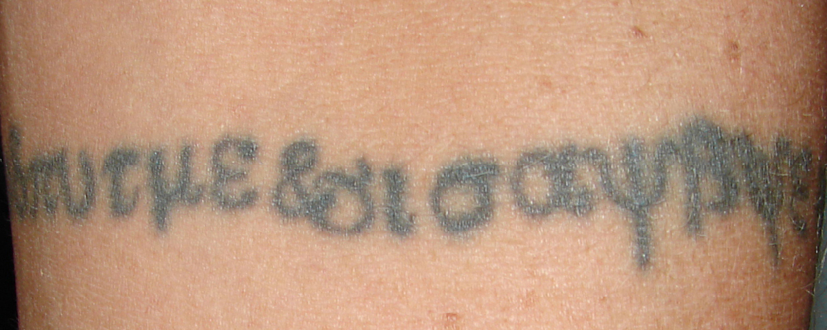 Tattooentfernung eines Schriftzugs vor der Behandlung