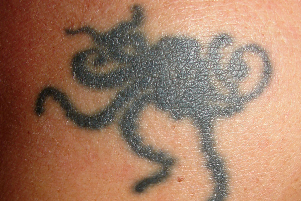 Tattooentfernung eines schwarzen Tattoos vor der Behandlung