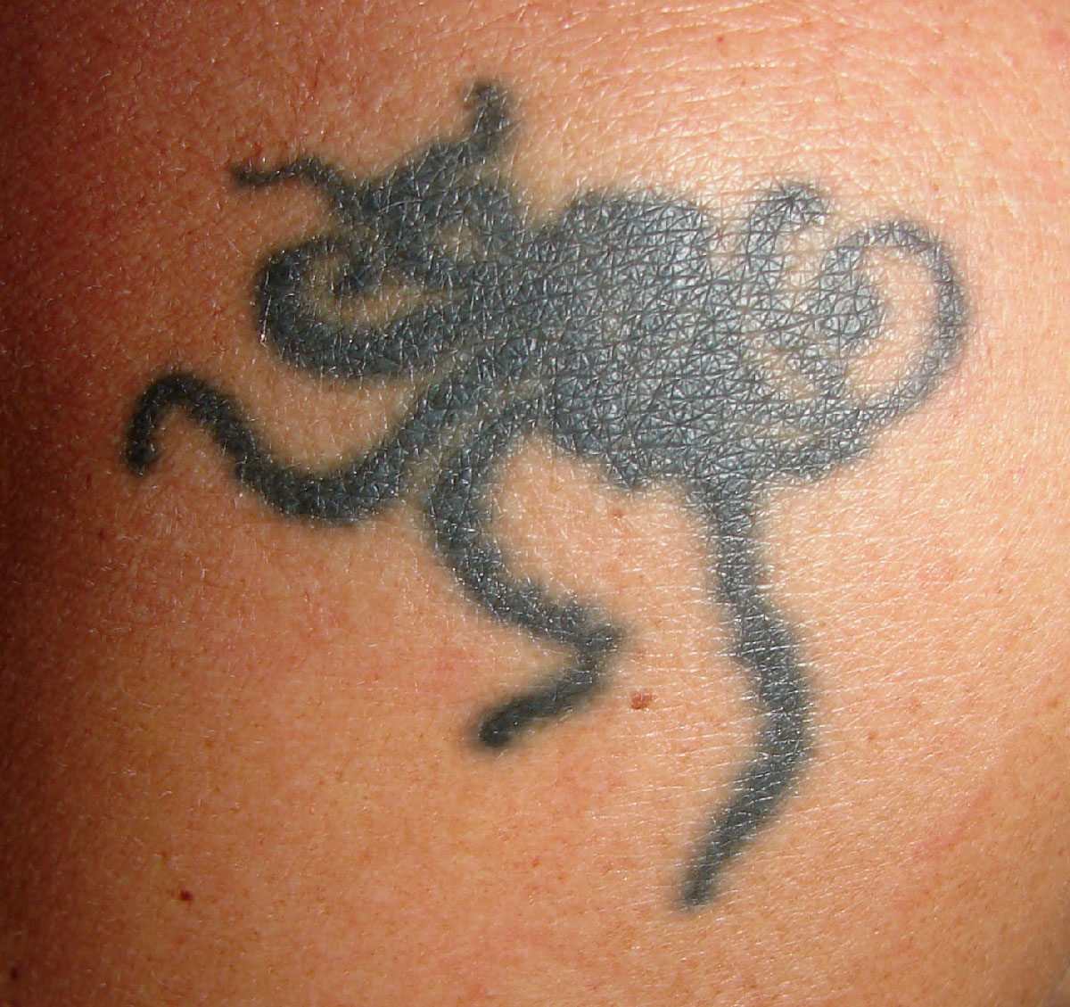 Tattooentfernung eines schwarzen Tattoos vor der Behandlung
