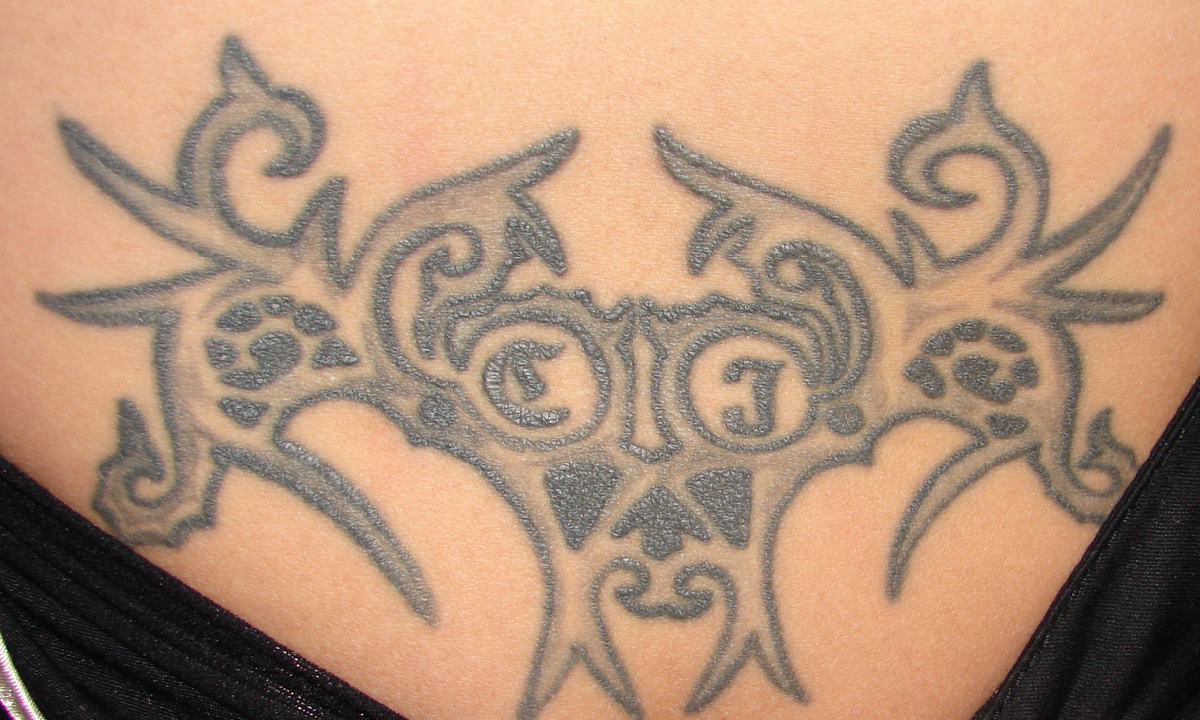 Tattooentfernung am Steißbein vor der Behandlung