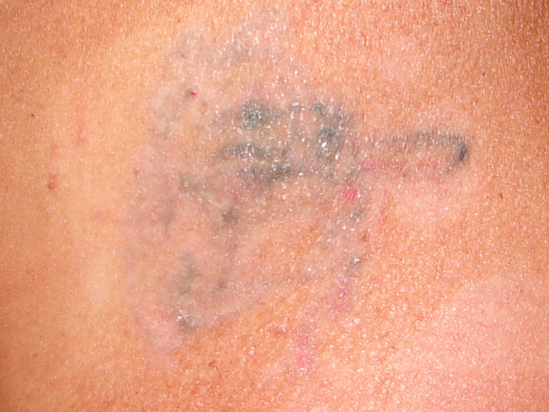 Tattooentfernung am Oberarm nach 2 Behandlungen