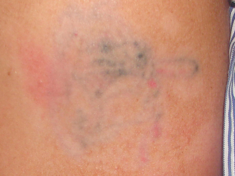 Tattooentfernung am Oberarm nach 3 Behandlungen