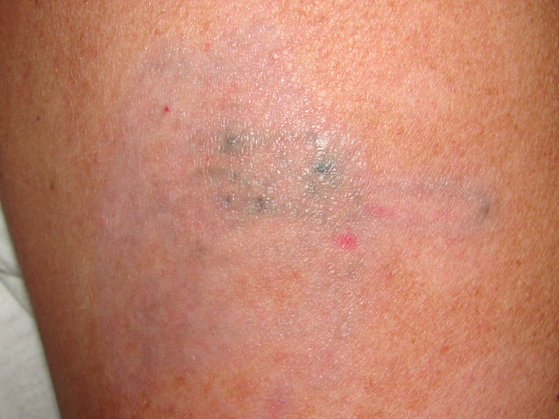 Tattooentfernung am Oberarm nach 5 Behandlungen