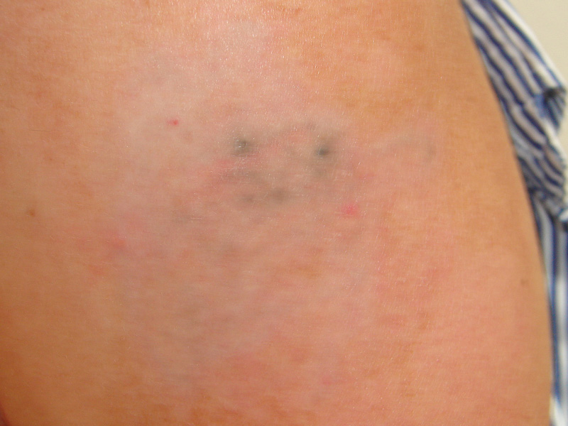 Tattooentfernung am Oberarm nach 6 Behandlungen