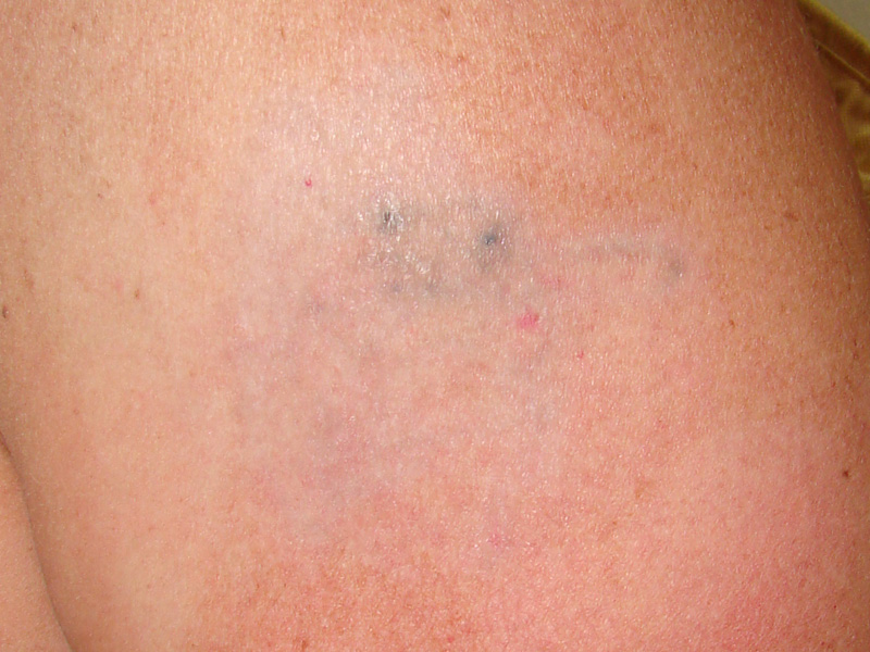 Tattooentfernung am Oberarm nach 8 Behandlungen