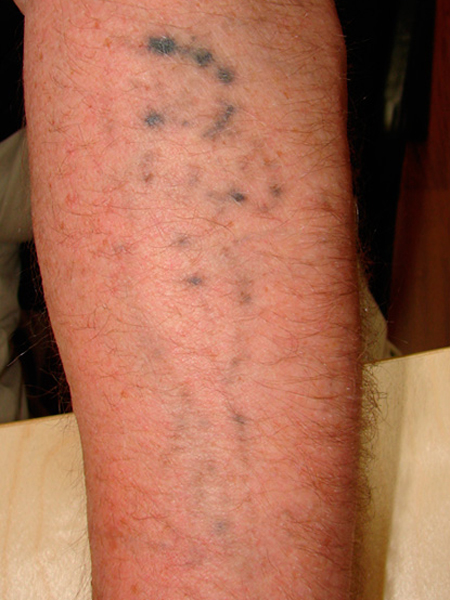 Tattooentfernung am Unterarm nach der 1. Behandlung