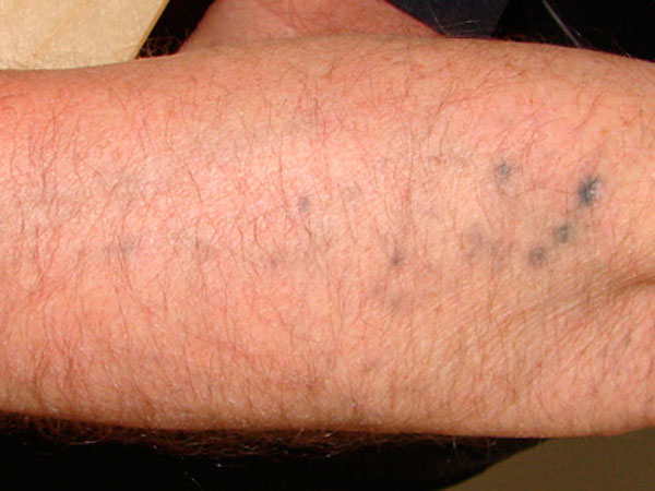 Tattooentfernung am Unterarm nach der 2. Behandlung