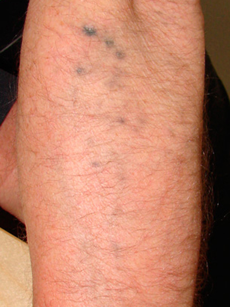 Tattooentfernung am Unterarm nach der 2. Behandlung