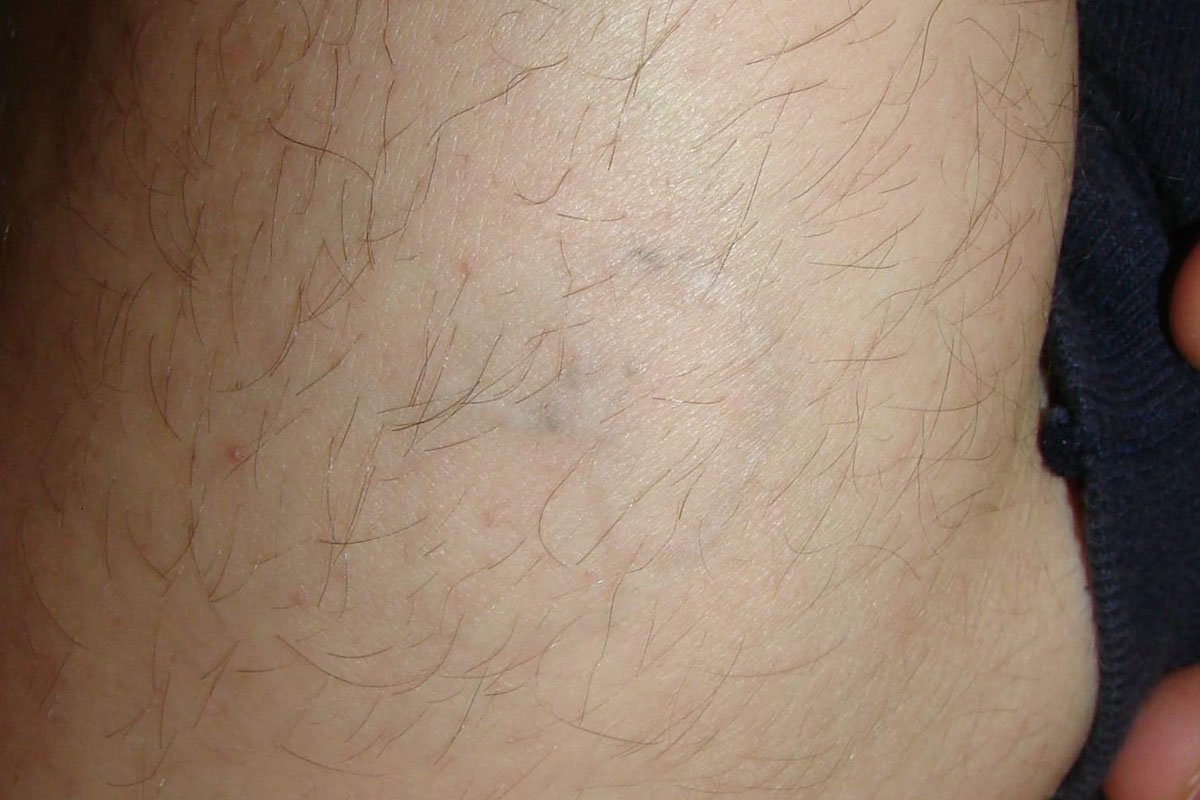 Tattooentfernung am Unterarm nach 6 Behandlungen