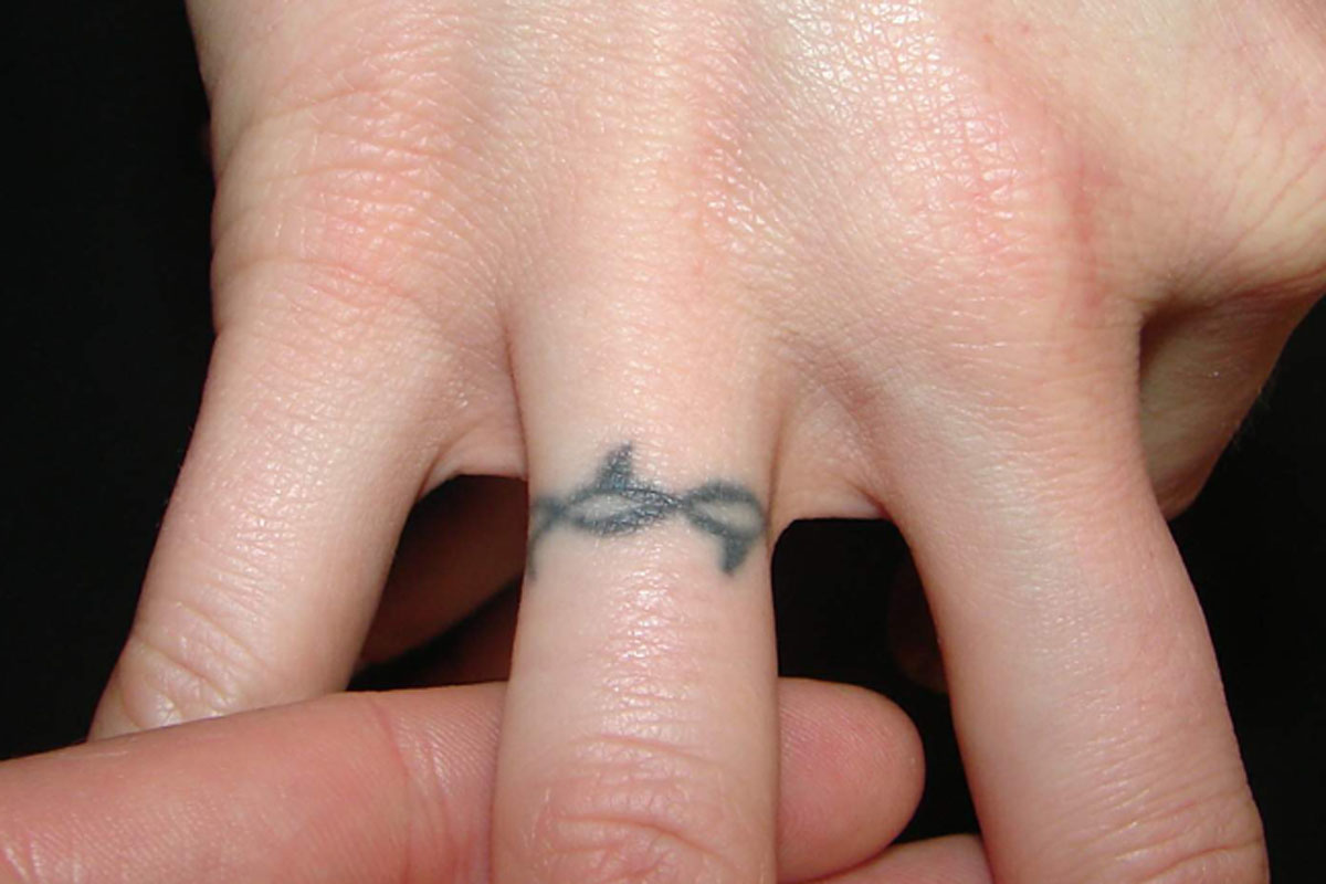 Tattooentfernung am Finger vor der Behandlung