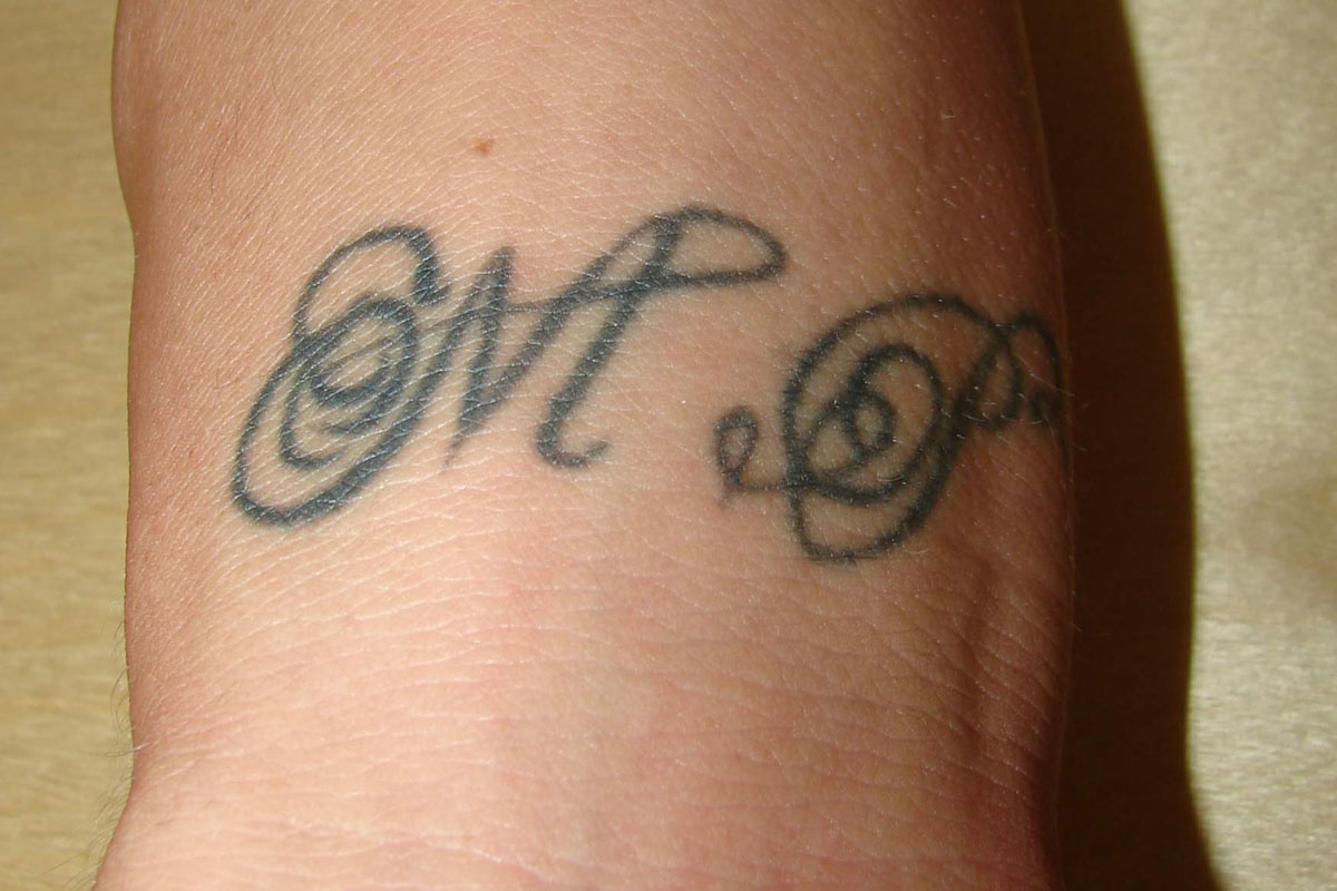 Tattooentfernung am Handgelenk vor der Behandlung