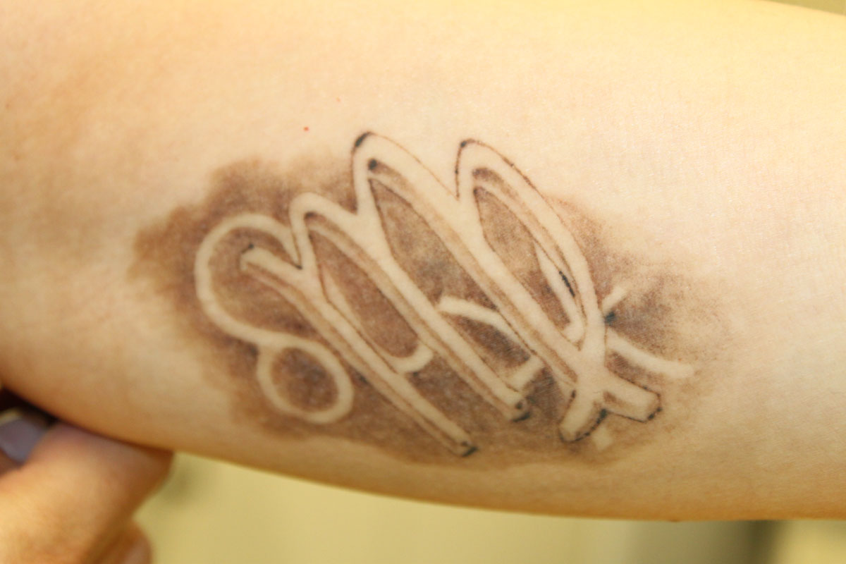 Tattooentfernung am Oberarm nach 4 Behandlungen