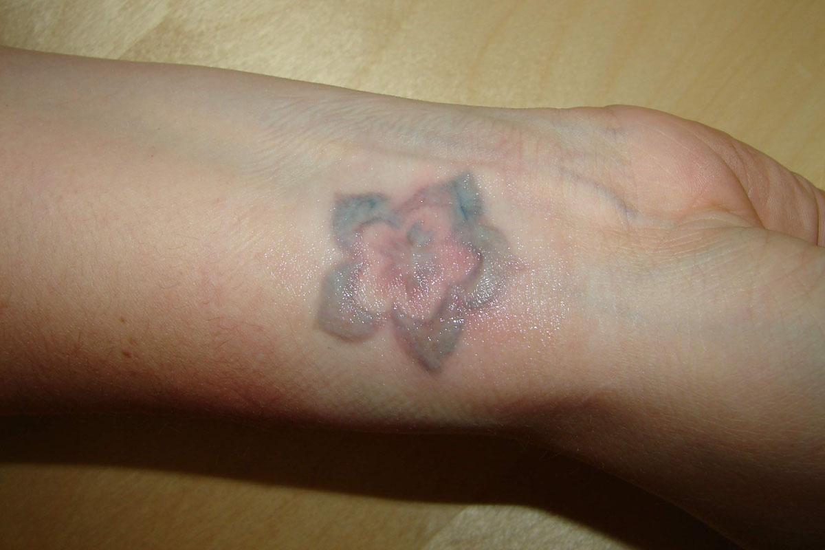 Tattooentfernung am Unterarm vor der Behandlung