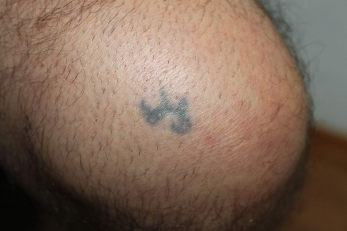 Tattooentfernung am Knie vor der Behandlung