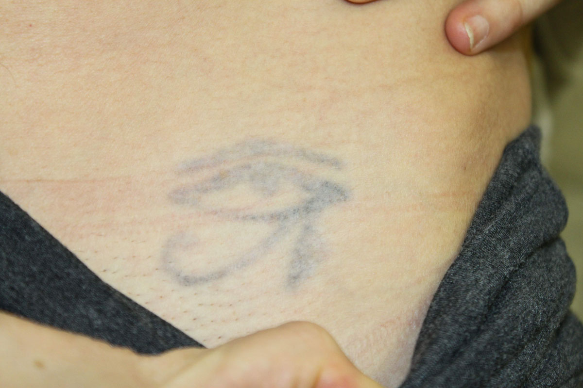 Tattooentfernung auf der Leiste nach 5 Behandlungen