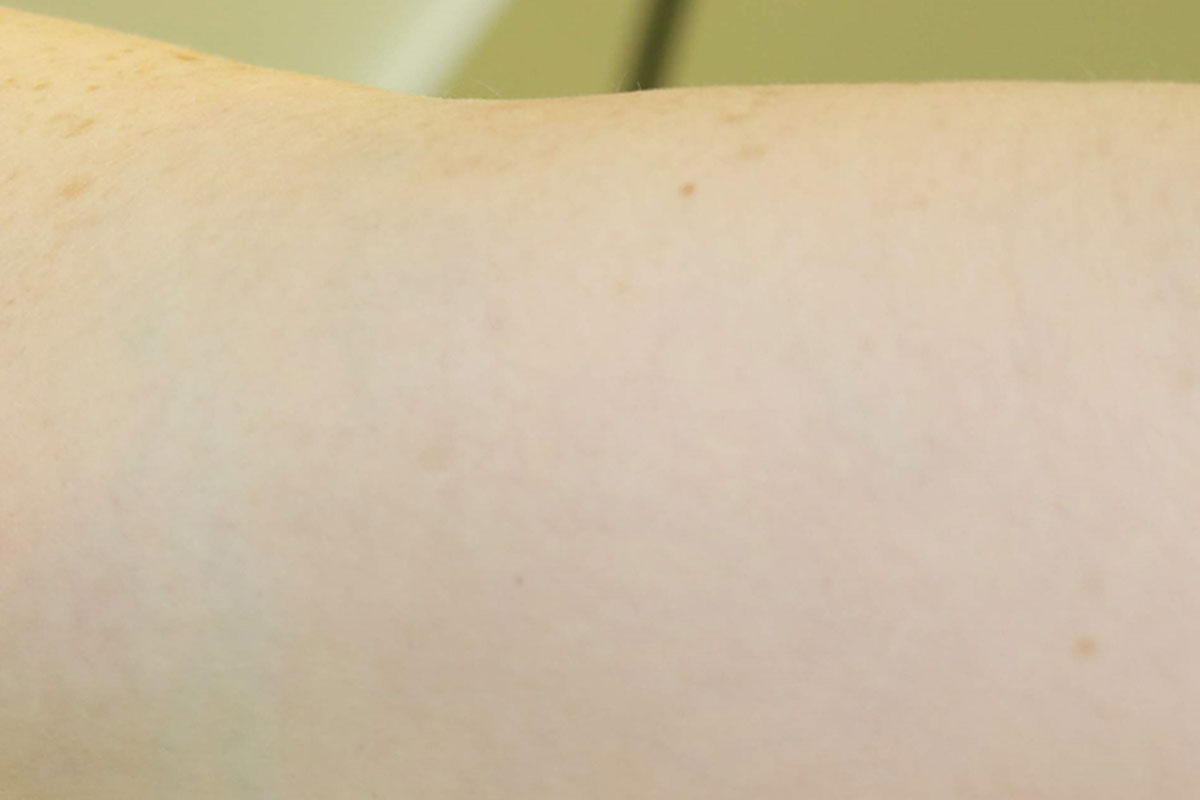 Tattooentfernung am Oberarm nach 12 Behandlungen