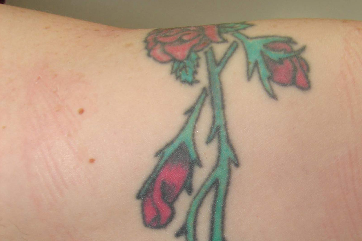 Tattooentfernung am Oberarm vor der Behandlung