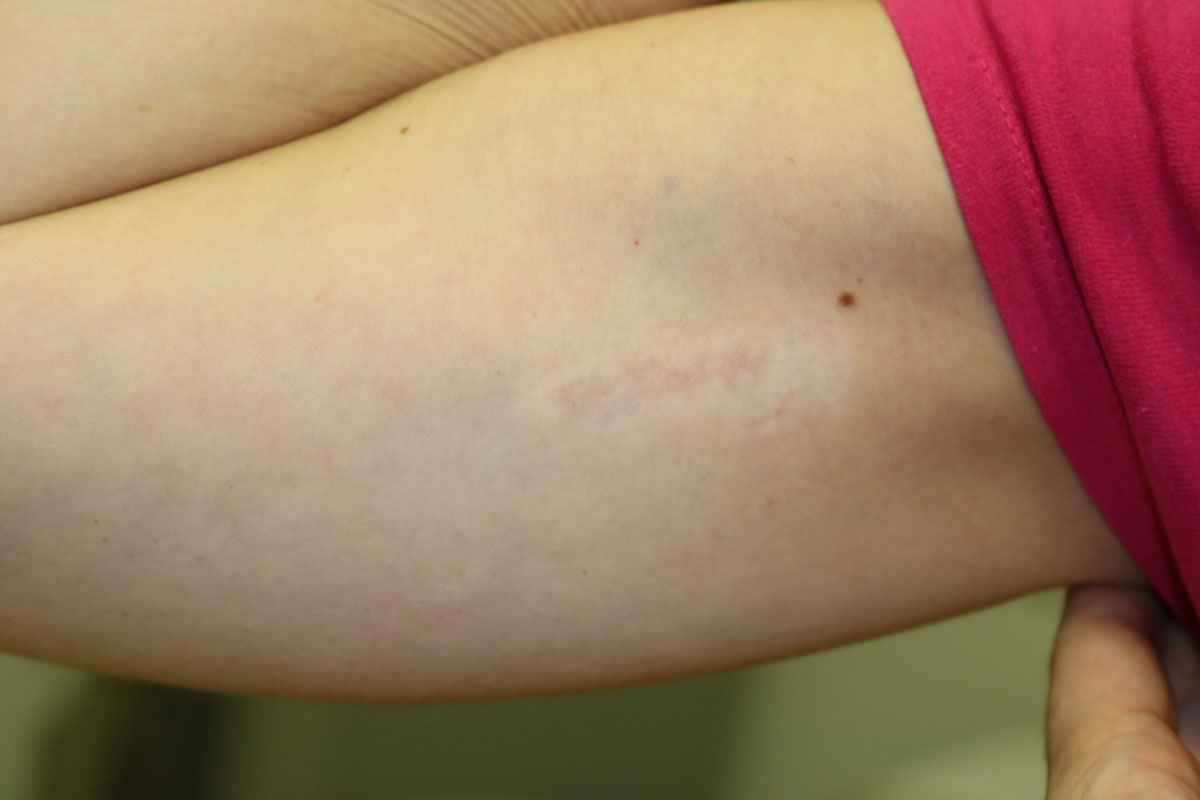 Tattooentfernung am Oberarm nach 14 Behandlungen