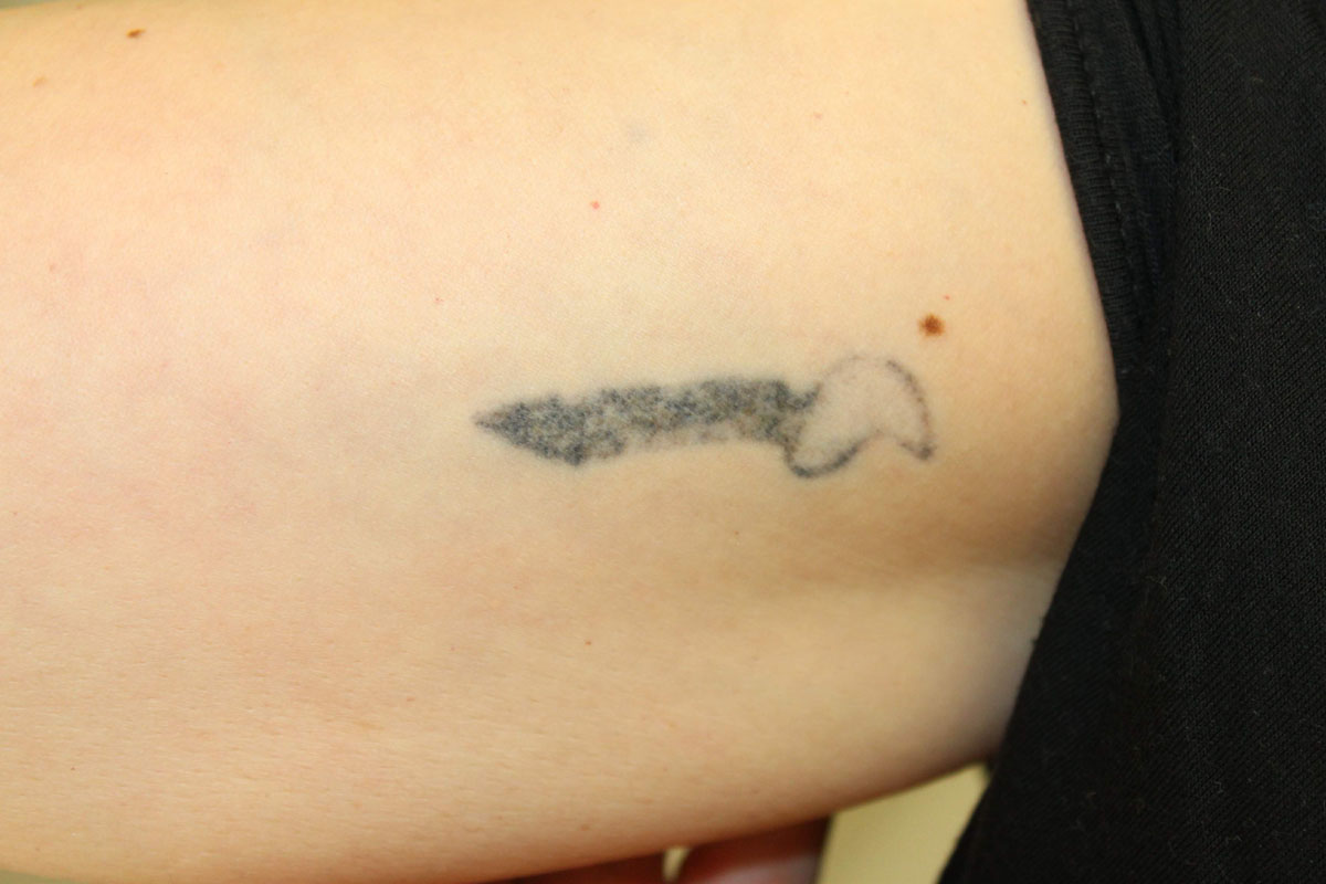 Tattooentfernung am Oberarm nach 7 Behandlungen