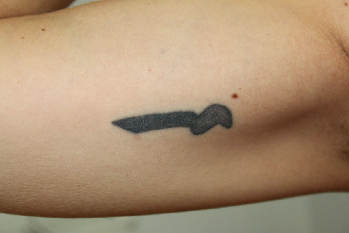 Tattooentfernung am Oberarm vor der Behandlung