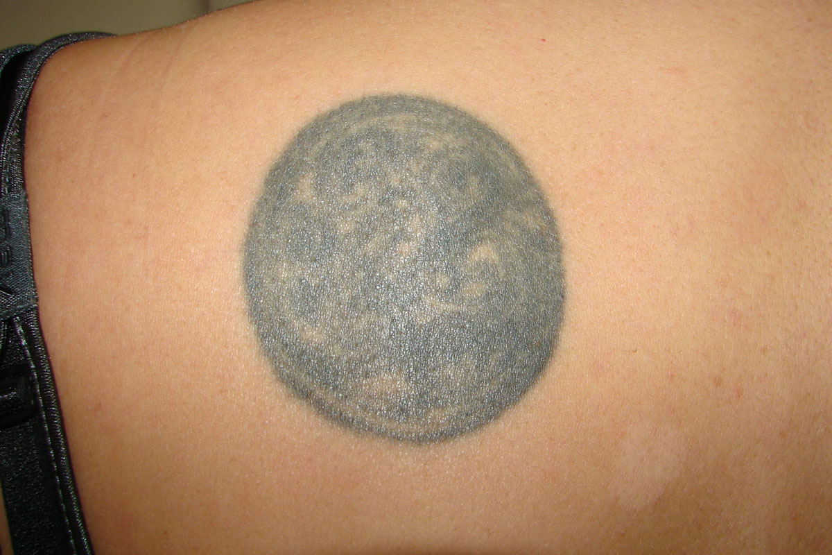 Tattooentfernung auf der Schulter vor der Behandlung