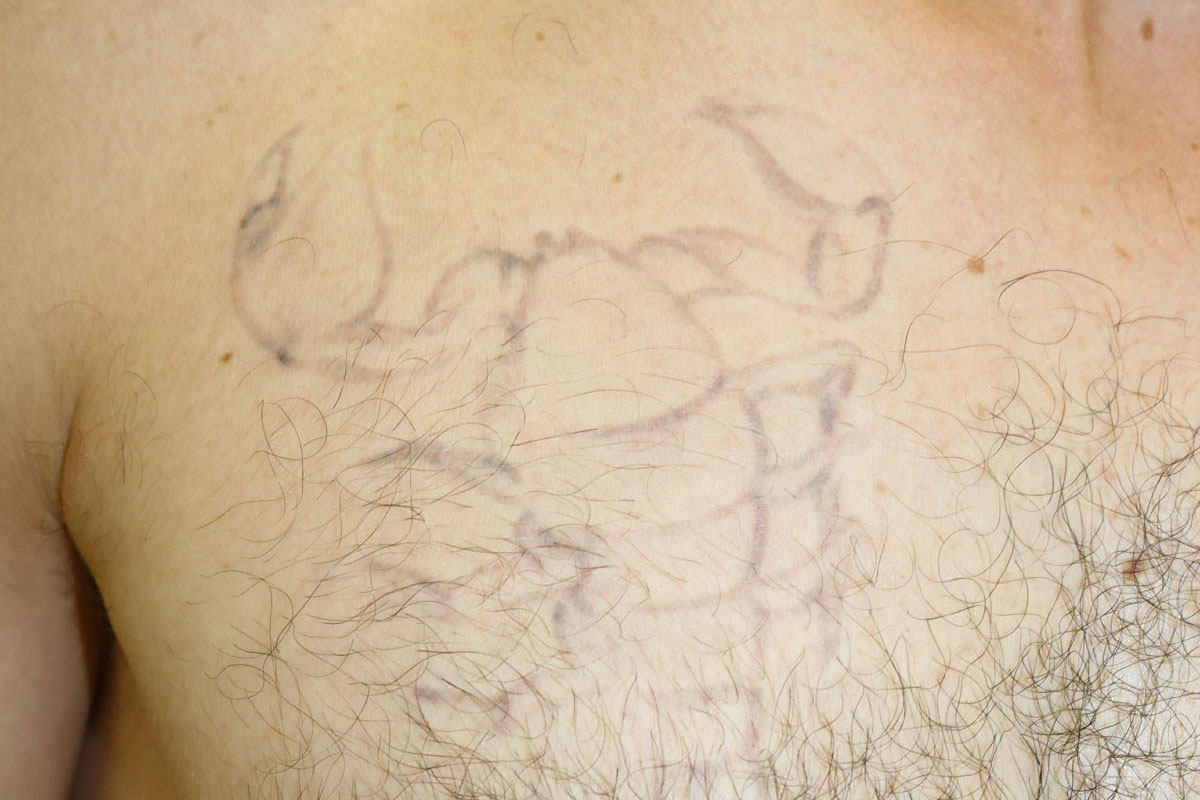 Tattooentfernung auf der Brust nach 16 Behandlungen