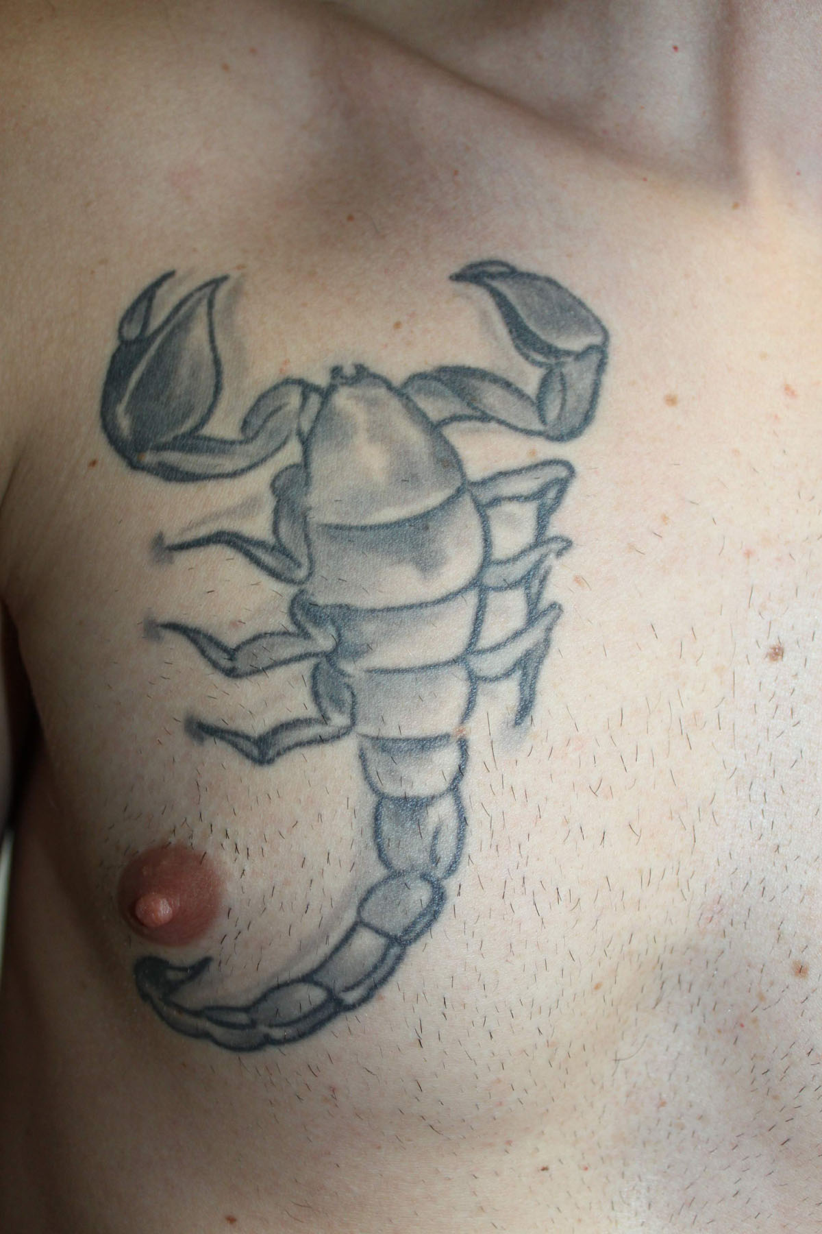 Tattooentfernung auf der Brust vor der Behandlung